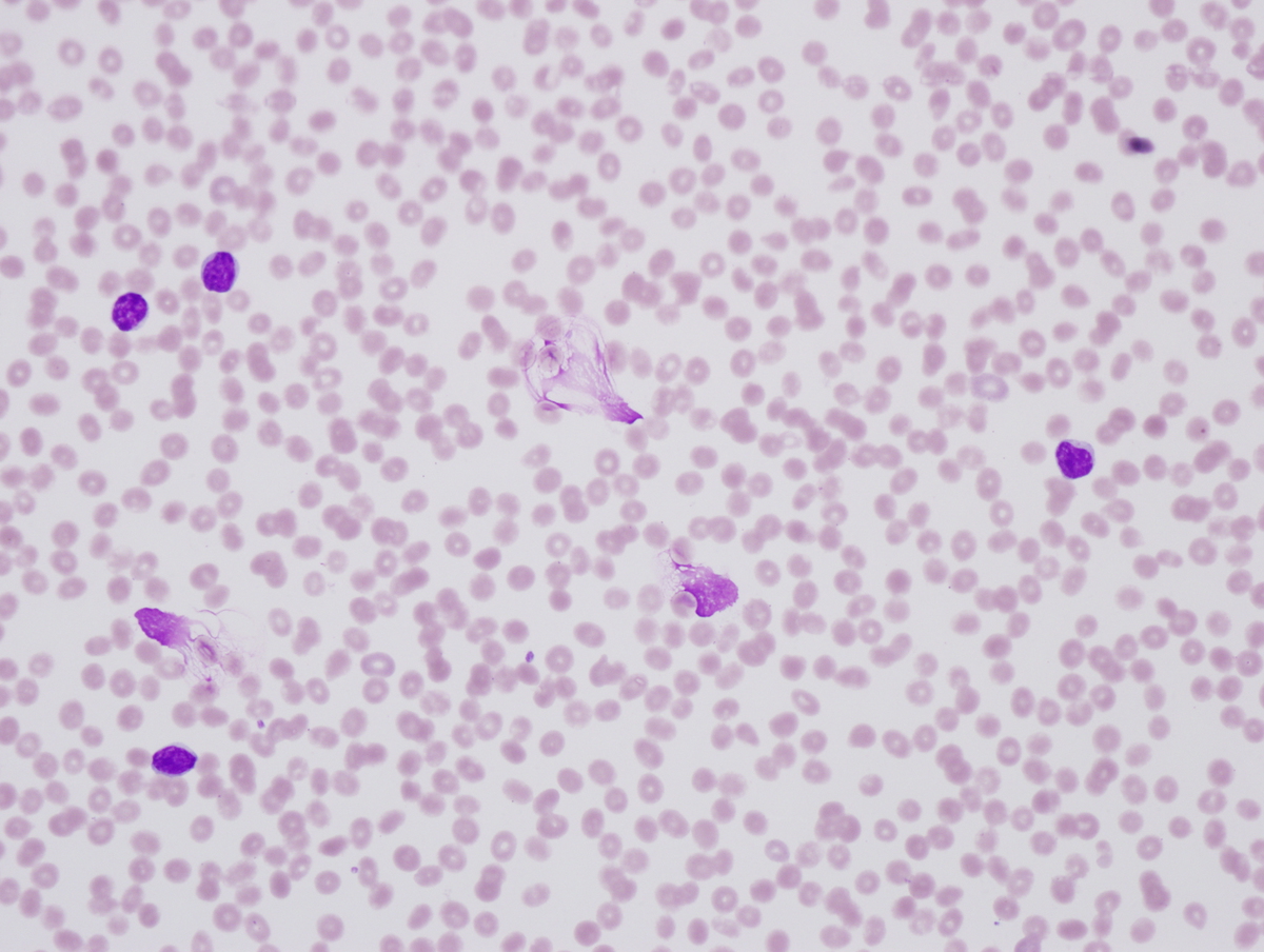 Fig. 10 Peripheral blood. Numerous mature appearing lymphocytes with coarsely clumped chromatin and smudge cells are present (Fig 10a). Occasional atypical immature mononuclear cells with similar morphologic features to those in the bone marrow are also identified (Fig. 10b).